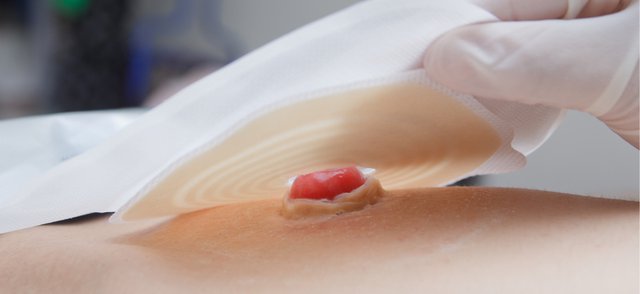 New device could 'revolutionise' lives of those living with stoma
