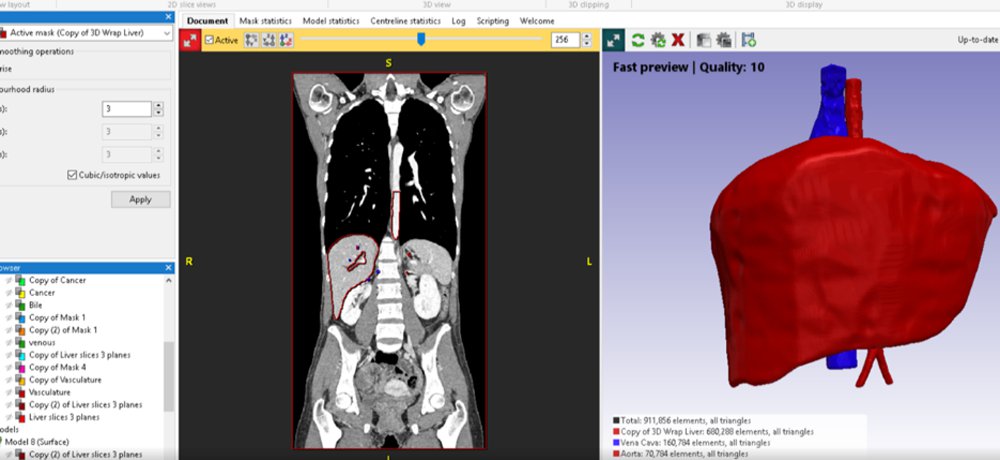 How Medical 3d Printing Helps Improve Patient Outcomes Med Tech Innovation Latest News For The Medical Device Industry