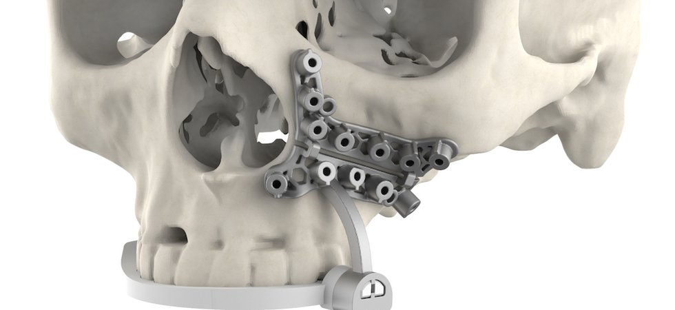 3D Systems Launches New Addition To VSP Surgical Portfolio - Med-Tech ...