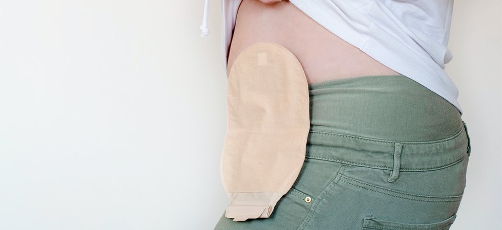 Colostomy Find the Right Colostomy Bag for Your Type