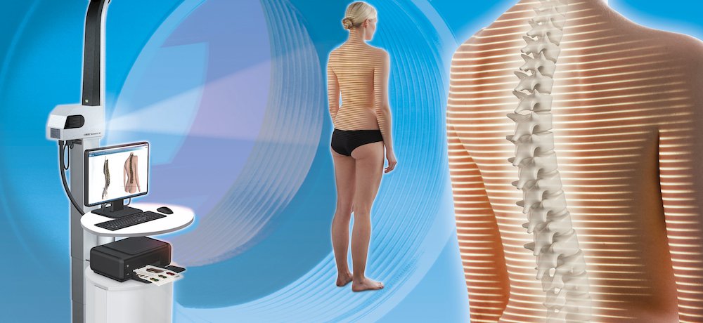 Optical spine and posture with uEye industrial - Med-Tech Innovation