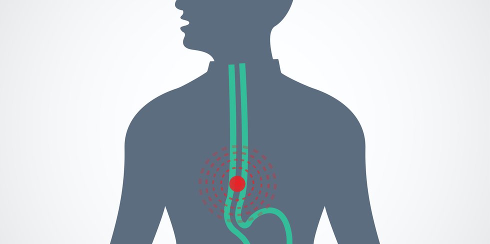 Incisionless Anti Reflux Surgery The Future Of Preventing Oesophageal   Oesaphagus 