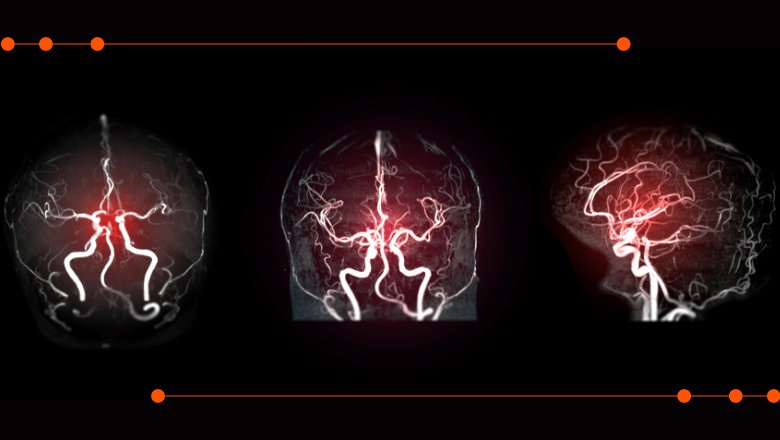 Robotics and AI combination has potential to improve safety in emergency stroke surgeries